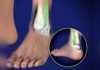 10 methods to cure high ankle sprain high ankle sprain