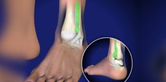 10 methods to cure high ankle sprain high ankle sprain