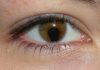 Broken Blood Vessel In Eye What Should Do broken blood vessel in eye