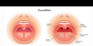 Food Stuck in Throat When You Can Still Breathe food stuck in throat