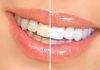4 Benefits To Whitening Your Teeth