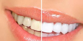 4 Benefits To Whitening Your Teeth