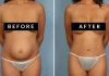Transforming Your Body After Pregnancy: Mommy Makeover Surgery