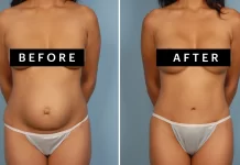 Transforming Your Body After Pregnancy: Mommy Makeover Surgery