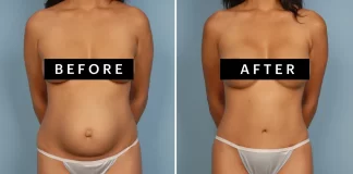 Transforming Your Body After Pregnancy: Mommy Makeover Surgery